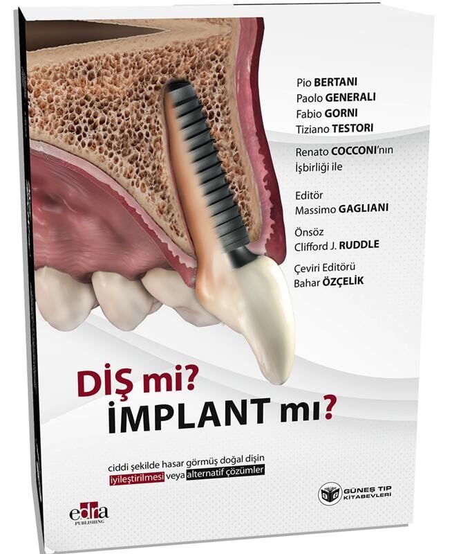 :  Diş mi? İmplant mı? (Doğal Dişin Korunması veya İmplant Çözümleri Üzerine Kapsamlı Rehber)