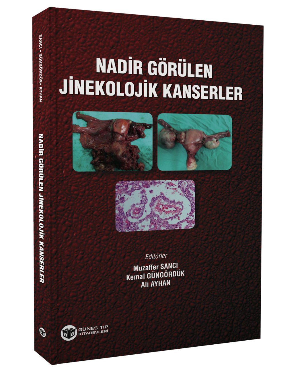 Nadir Görülen Jinekolojik Kanserler